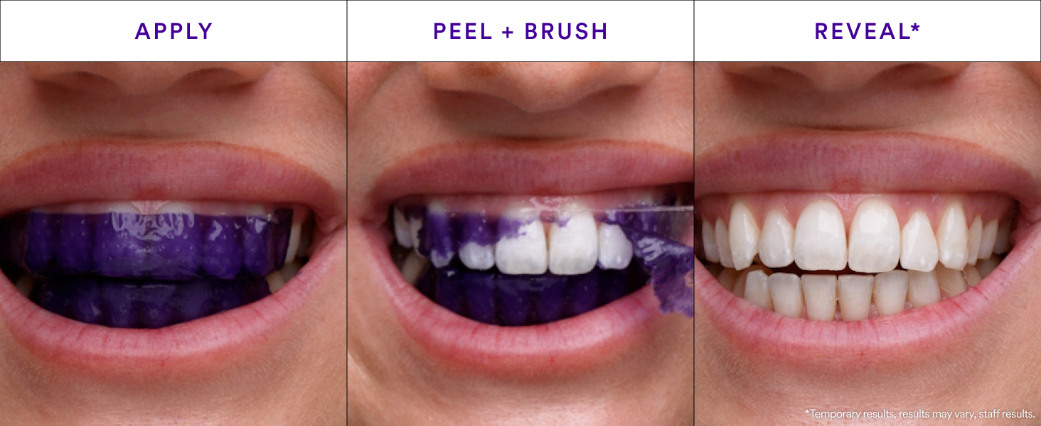 Hismile V34 Teeth Whitening Strips Review: Instant Bright Smile?