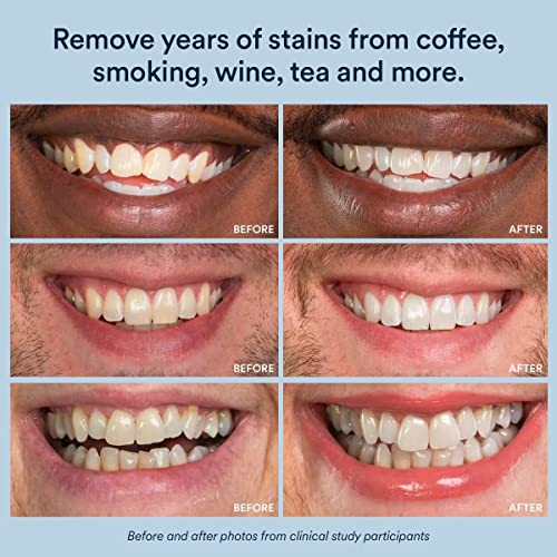 Best OTC Teeth Whitening: Top 5 Picks 2026